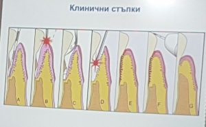 лазерно лечение на зъби и венци Пловдив лазерно лечение на зъби и венци Пловдив